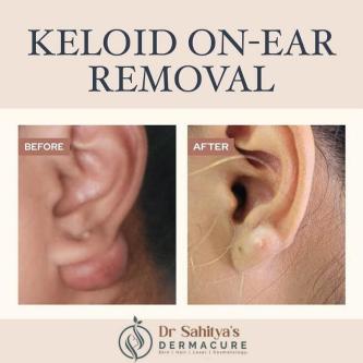 Keloid Treatment In Rajahmundry- in Patamata - Image 1