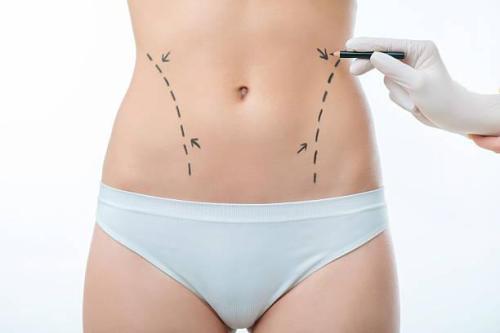 Liposuction surgery in Riyadh in Kerala - Image 2