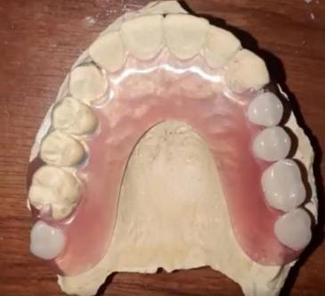 PRÓTESIS TOTALES, PLACAS DENTALES en Quito - Imagen 5