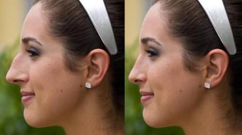 Rhinoplasty surgery in Riyadh in Taliparamba - Image 1