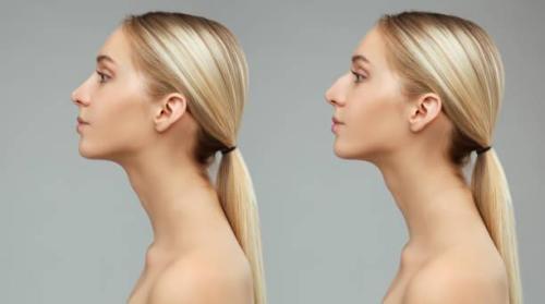 Rhinoplasty surgery in Riyadh in Taliparamba - Image 2