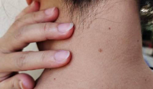 Skin Tag Removal in Riyadh in Kolkata - Image 1