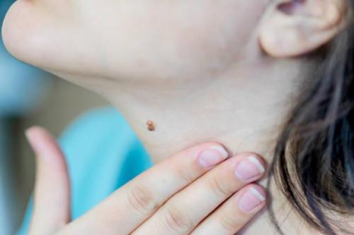 Skin Tag Removal in Riyadh in Kolkata - Image 2