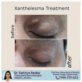 Xanthelasma And Treatment In Rajahmundry in Patamata - Image 1